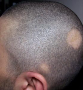 Contro l'alopecia, "cura del vampiro"